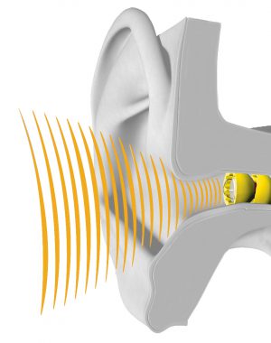 Lyric hearing aid in ear